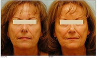 Mole Removal
