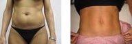 Mommy Makeover Mini Tummy Tuck and Slimlipo Laser Liposuction