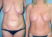 Tummy Tuck + Liposuction + Breast Lift + Implants