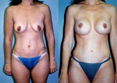 Post-Pregnancy Breast Augmentation Mastopexy + Tummy Tuck