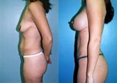 Post-Pregnancy Breast Augmentation Mastopexy + Tummy Tuck