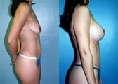 Post-Pregnancy Breast Augmentation Mastopexy + Tummy Tuck