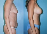 Tummy Tuck, Breast Augmentation, Lipo