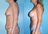 Tummy Tuck, Breast Augmentation, Lipo