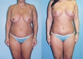 Mini Tummy Tuck with Lipo & Vertical Breast Lift
