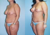 Mini Tummy Tuck with Lipo & Vertical Breast Lift