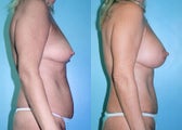 Breast Lift + Augmentation & Tummy tuck