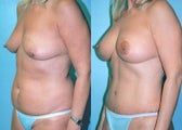 Breast Lift + Augmentation & Tummy tuck