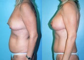 Breast Lift + Augmentation & Tummy tuck