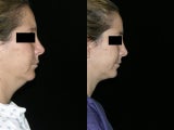 Neck Lipectomy