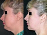 Neck Lipectomy