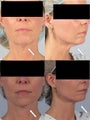 Platysmaplasty for neck muscle bands