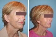 Neck lift