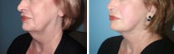 Neck lift