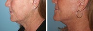 Neck lift