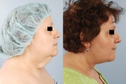 Facelift / necklift by Dr. Brett Kotlus