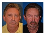 59 Year Old Male FaceLift