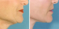 Neck Lift