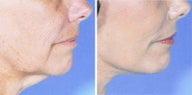 Neck Lift