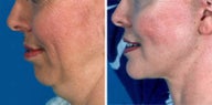 Neck Lift
