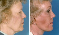 Neck Lift