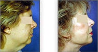 Neck Lift