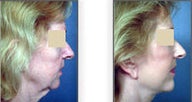 Neck and face lift
