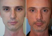Rhinoplasty, Chin Implant