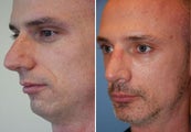 Rhinoplasty, Chin Implant