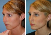 Chin Implant, Rhinoplasty