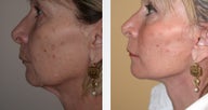 Necklift