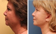 Necklift