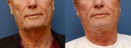 Necklift