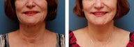 Necklift