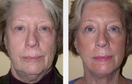 Necklift