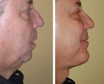Necklift