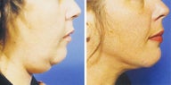 Face/Neck