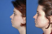 Neck lift