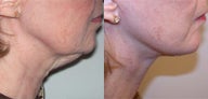 Neck lift