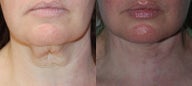 necklift