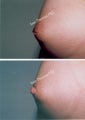 Nipple Surgery