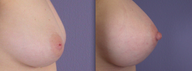 Nipple Surgery