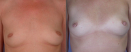 Nipple Surgery