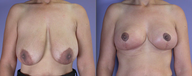 Nipple Surgery