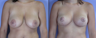 Nipple Surgery
