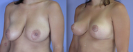 Nipple Surgery