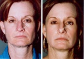 Non-Surgical Face Lift- Exoderm