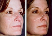 Non-Surgical Face Lift- Exoderm