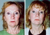 Non-Surgical Face Lift- Exoderm