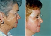 Non-Surgical Face Lift- Exoderm